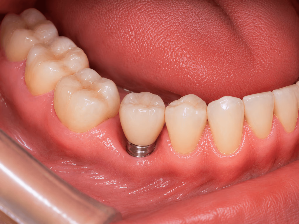 Dental implant treatment before and after